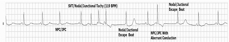 Nodal (junctional) escape beat Rhythm Strip